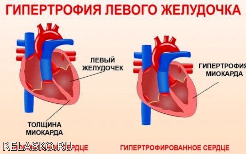 Желудочка сердца расширена. Гипертрофия левого желудочка при артериальной гипертензии. Гипертрофия миокарда левого левого желудочка сердца. Гипертрофия миокарда левого желудочка сердца что это такое. Миокарда левого желудочка сердца что это такое.